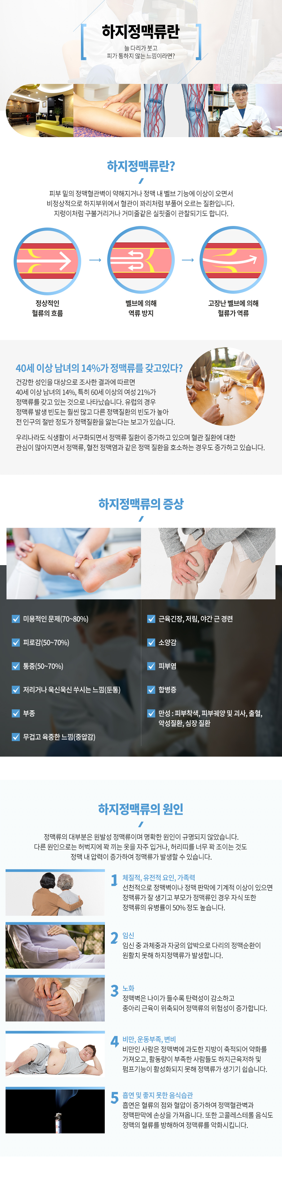 하지정맥류란