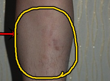 레이저 수술 약 15일 후 